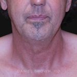 Neck Restoration Before & After Patient #10610