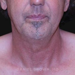 Neck Restoration Before & After Patient #10610