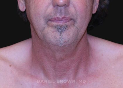 Neck Restoration Before & After Patient #10610