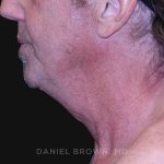 Neck Restoration Before & After Patient #10610