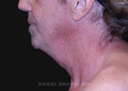 Neck Restoration Before & After Patient #10610