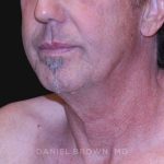 Neck Restoration Before & After Patient #10610