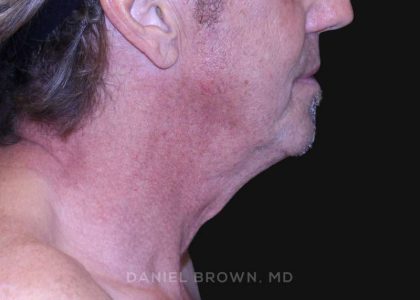 Neck Restoration Before & After Patient #10610