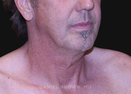 Neck Restoration Before & After Patient #10610