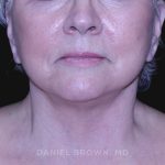 Neck Restoration Before & After Patient #10621