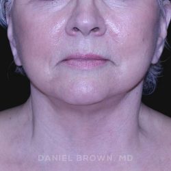 Neck Restoration Before & After Patient #10621