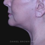 Neck Restoration Before & After Patient #10621