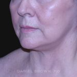 Neck Restoration Before & After Patient #10621