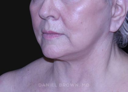 Neck Restoration Before & After Patient #10621