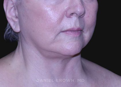 Neck Restoration Before & After Patient #10621