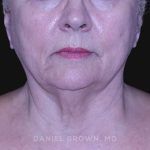 Neck Restoration Before & After Patient #10621