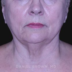 Neck Restoration Before & After Patient #10621