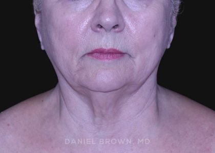 Neck Restoration Before & After Patient #10621