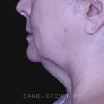 Neck Restoration Before & After Patient #10621