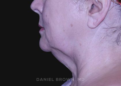 Neck Restoration Before & After Patient #10621