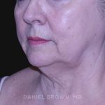 Neck Restoration Before & After Patient #10621