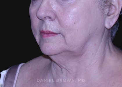 Neck Restoration Before & After Patient #10621