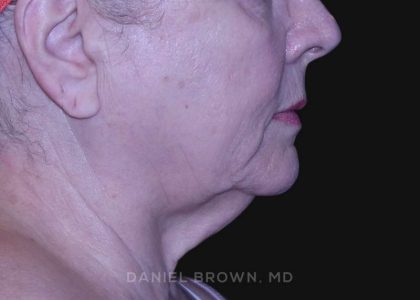 Neck Restoration Before & After Patient #10621