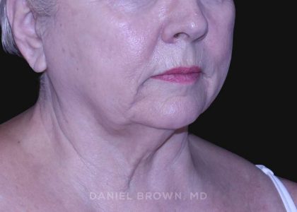Neck Restoration Before & After Patient #10621