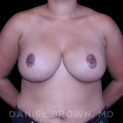 Bellesoma Breast Lift Before & After Patient #8355