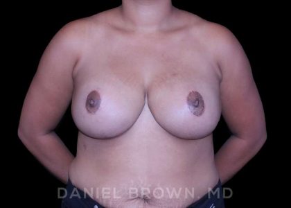 Bellesoma Breast Lift Before & After Patient #8355