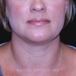 Neck Restoration Before & After Patient #10632