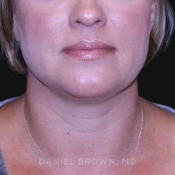 Neck Restoration Before & After Patient #10632