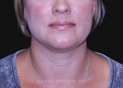 Neck Restoration Before & After Patient #10632