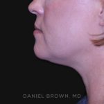 Neck Restoration Before & After Patient #10632