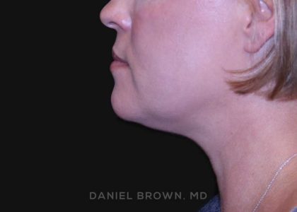 Neck Restoration Before & After Patient #10632