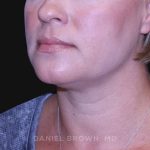 Neck Restoration Before & After Patient #10632