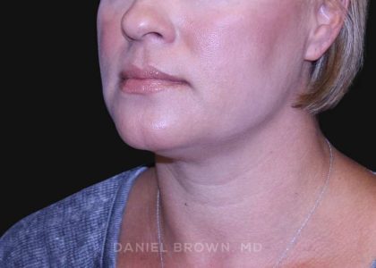 Neck Restoration Before & After Patient #10632