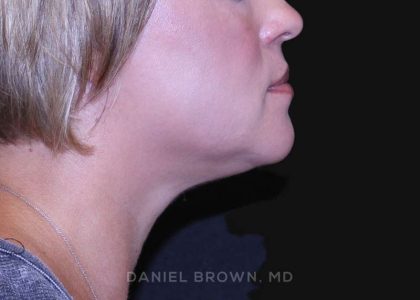 Neck Restoration Before & After Patient #10632