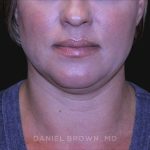 Neck Restoration Before & After Patient #10632