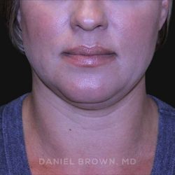 Neck Restoration Before & After Patient #10632