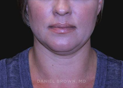 Neck Restoration Before & After Patient #10632