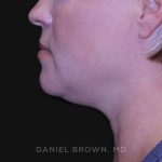 Neck Restoration Before & After Patient #10632