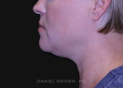 Neck Restoration Before & After Patient #10632