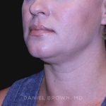Neck Restoration Before & After Patient #10632