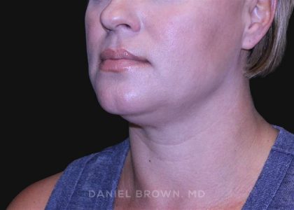 Neck Restoration Before & After Patient #10632