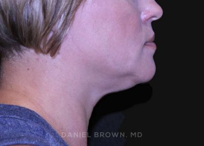 Neck Restoration Before & After Patient #10632