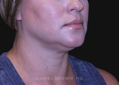 Neck Restoration Before & After Patient #10632