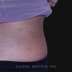 Mole Removal Before & After Patient #10345