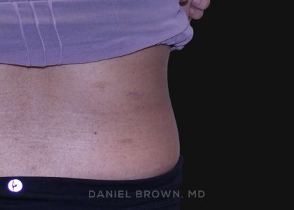 Mole Removal Before & After Patient #10345