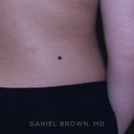 Mole Removal Before & After Patient #10345
