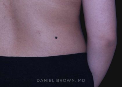 Mole Removal Before & After Patient #10345