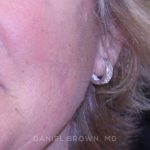 Mole Removal Before & After Patient #10352