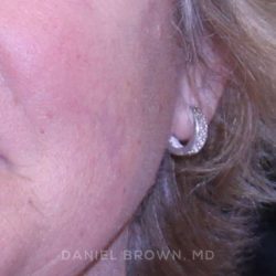 Mole Removal Before & After Patient #10352