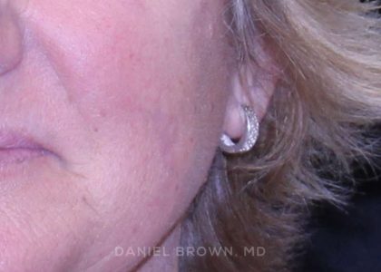 Mole Removal Before & After Patient #10352