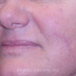 Mole Removal Before & After Patient #10352